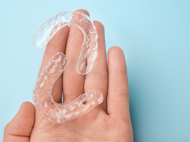 Clear aligners resting on a hand used for orthodontic treatment.