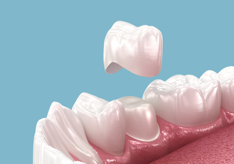 Dental crown placement illustration restoring a damaged tooth.