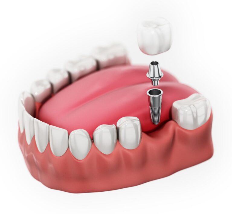 Dental implant illustration showing titanium implant placed into the jawbone.