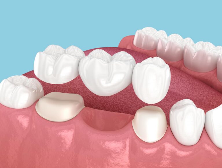 Dental bridge illustration replacing a missing tooth between healthy teeth.