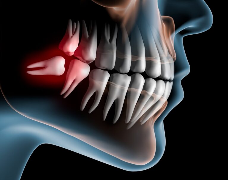 Illustration showing impacted wisdom teeth causing jaw pain.