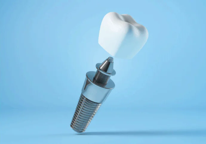 Dental Implant in Fort Worth, TX at Covenant Dental